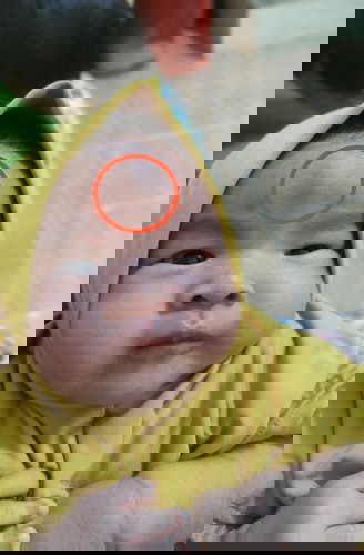 Benjolan di tengah dahi/kening sejak lahir