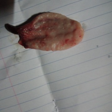 หลังคลอด ประจำเดือนผิดปกติ ปวดท้องประจำเดื่อนมีสิ่งแปลกออกจากช่องคลอด คืออะไรค่ะ