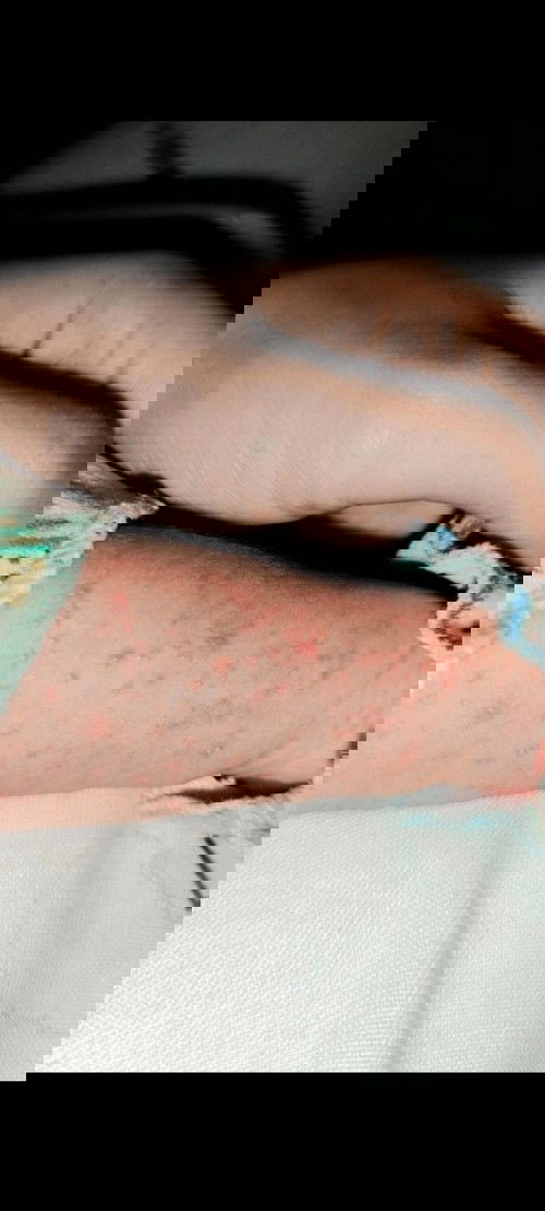 Bintik merah pada bayi