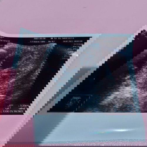 Hamil 7W tapi usia janin 5W