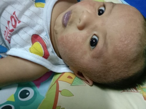 คุณแม่บ้านไหนน้องขึ้นผื่นแดงที่หน้าบ้างค่ะมีวิธีแนะนำไหมค่ะน้องขึ้นผื่นเยอะมากค่ะ