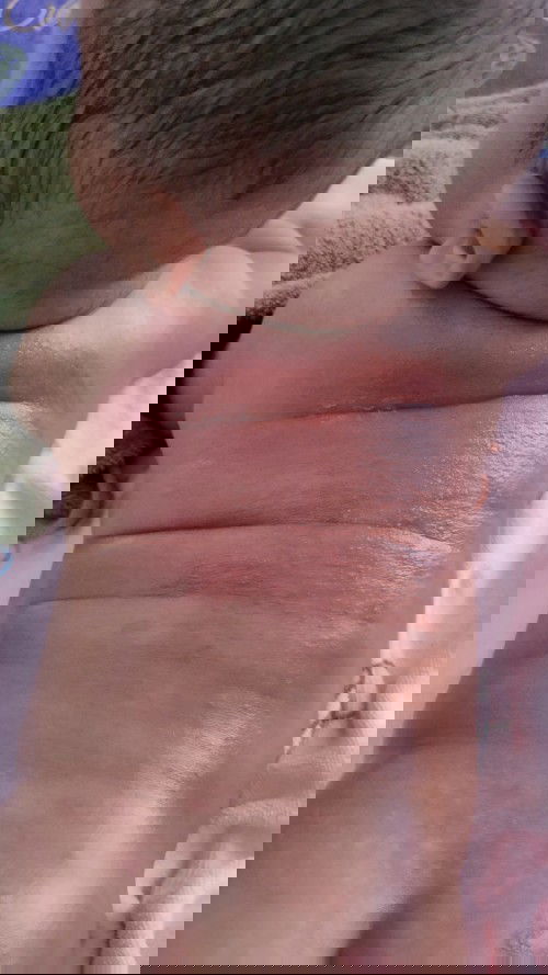 Kulit merah panas melepuh