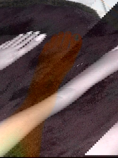 มีแม่ๆคนไหนเป็นมั้งมั้ยค่ะ เท้าเพิ่งมาบวมหลังคลอด บวมจนรู้สึกว่าเวลางอจะบวมตรงข้อเท้า