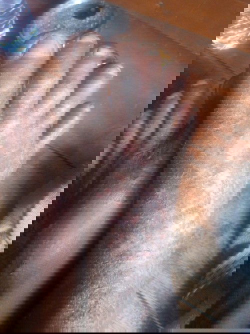 Kaki ayahku sakit bengkak