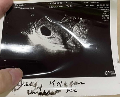 ตรวจตอนประมาน7วีค ไม่เจอตัวอ่อนยังมีหวังมั้ยคะ