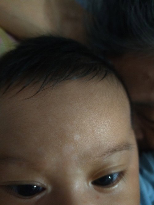 bercak putih dikening