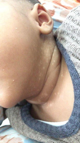 Bayi kulitnya putih putih di leher, hilangnya pakai apa ya?
