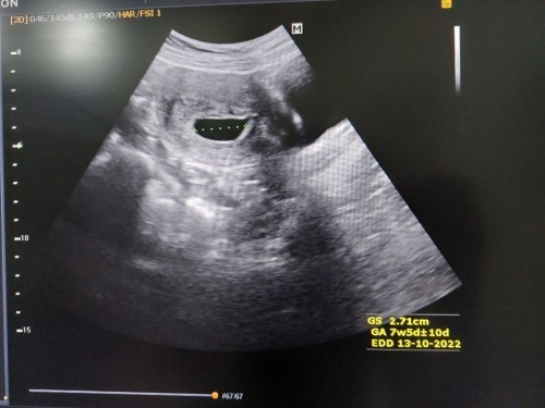 ซาวด์เห็นน้องตอนอายุครรภ์เท่าไรกันบ้างค่ะ