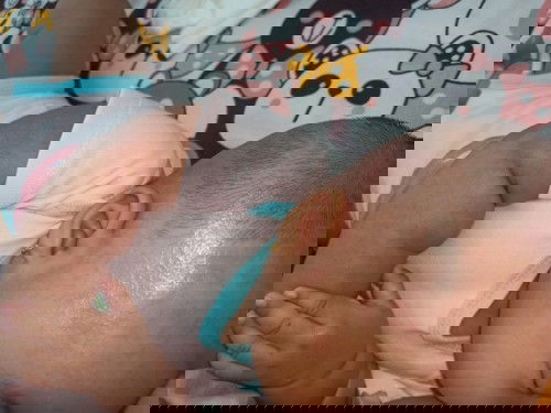 Biang keringat tidak kunjung sembuh