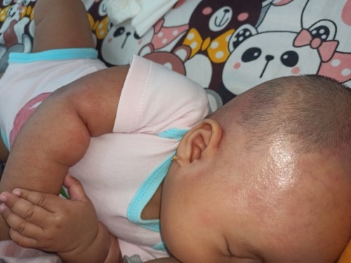 Biang keringat tidak kunjung sembuh