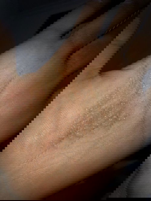 Eksim atau alergi sabun cuci dot bayi