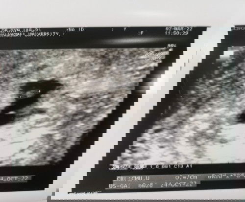 หัวใจน้องไม่เต้น😥