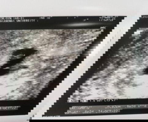 หัวใจน้องไม่เต้น😥