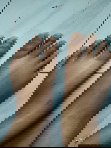 คุณแม่ท่านใด มือเท้าบวมตั้งแต่ 20W ไหมคะ จะเป็นอันตรายไหม