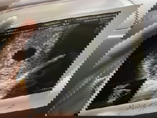 10week masih tak nampak janin.