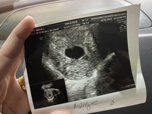 10week masih tak nampak janin.