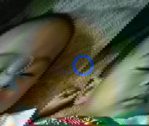 Putih2 diwajah bayi seperti panu