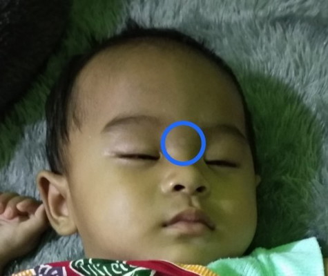 Putih2 diwajah bayi seperti panu