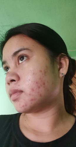 PIMPLES PROBLEM