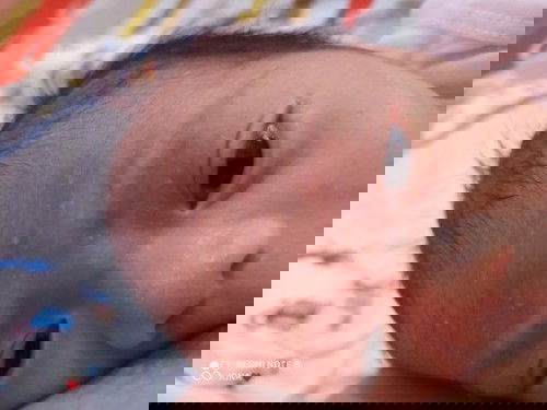 Pimple like na lumabas sa mukha ni baby