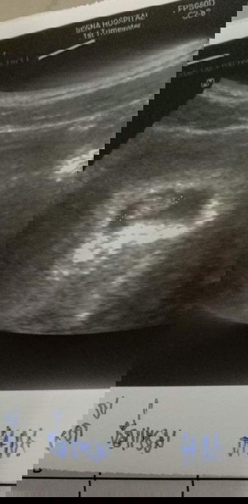 ท้องแรกแต่ท้องยังไม่ออก