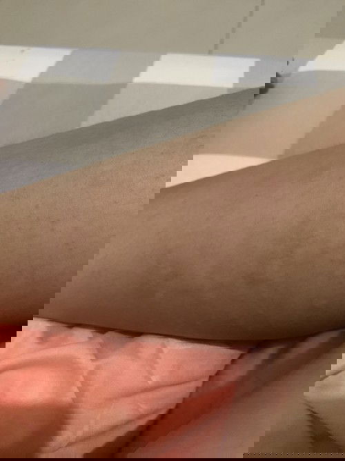 Betol Gatal Saat hamil