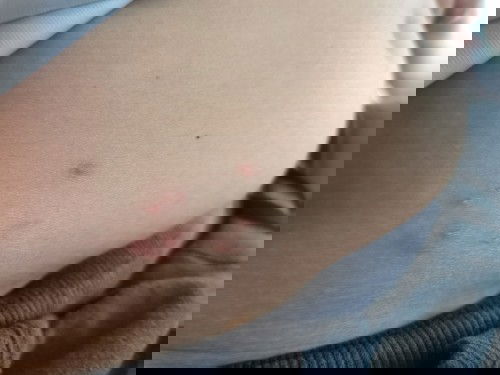 Rashes or insect bites