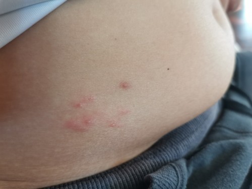 Rashes or insect bites