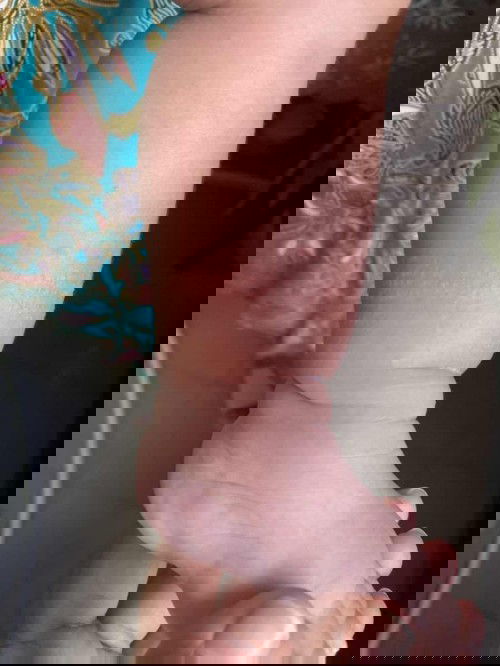 ลูกมีผื่นคันรอบวงขา เหมือนแพ้ถุงเท้า