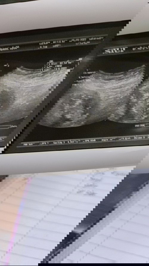 Posisi bayi turun ke bawah (kontraksi) usia kehamilan 3 bulan