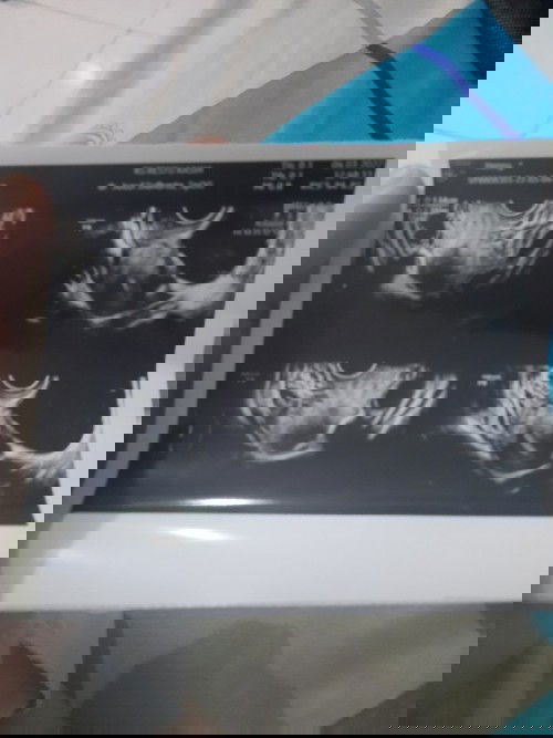 Keguguran dan ternyata di rahim ada kista