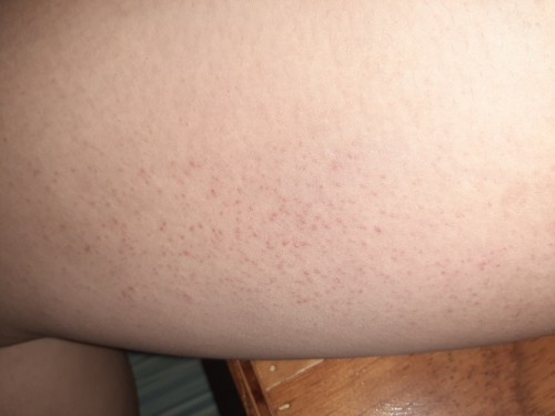 rashes o chicken skin?