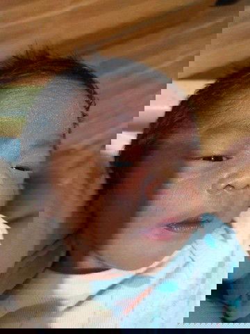 infant prickly heat rash