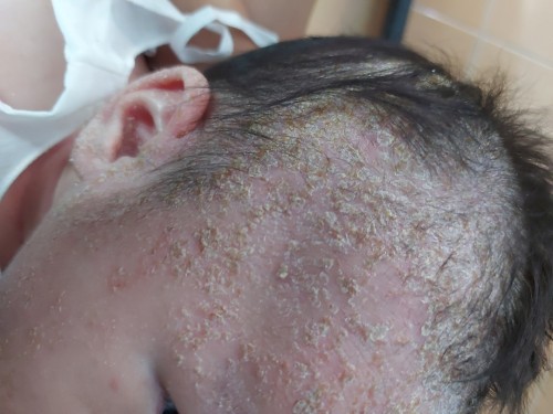 ผิวแห้งมาก