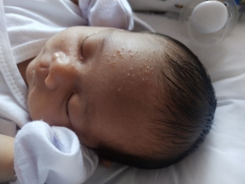 14days old butlig sa mukha