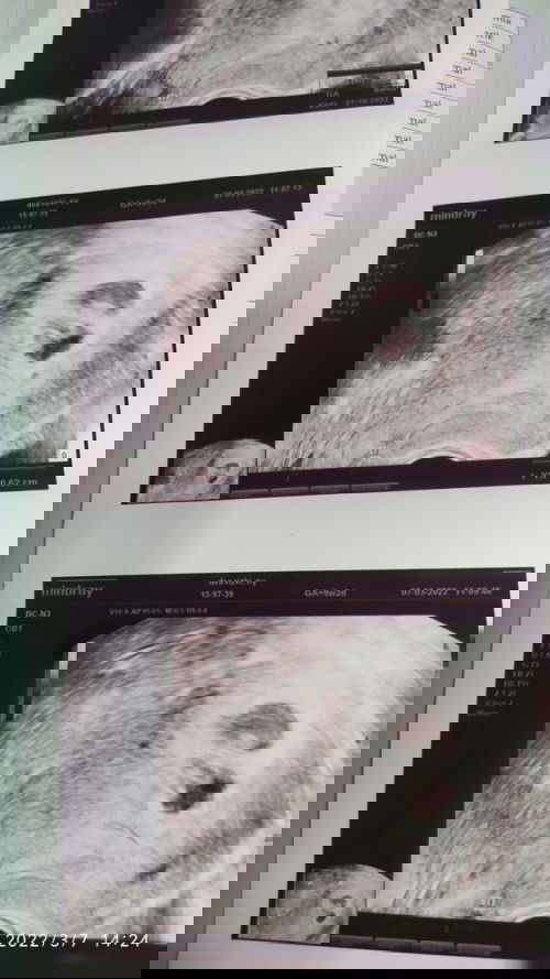 USG Transvaginal ternyata tidak sakit