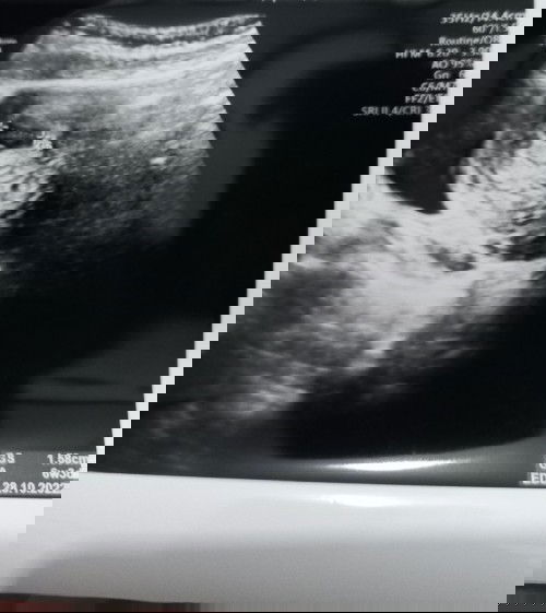 Pendarahan di usia 6 minggu, share pengalaman moms dong