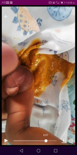 สงสัยคะว่าปกติไหม แรกเกิดก่อนหน้านี้อึวันละ3 -​4รอบ
เมื่อวานไม่อึ  วันนี้พึีงอึ1รอบคะ