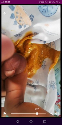 สงสัยคะว่าปกติไหม แรกเกิดก่อนหน้านี้อึวันละ3 -4รอบ
เมื่อวานไม่อึ วันนี้พึีงอึ1รอบคะ