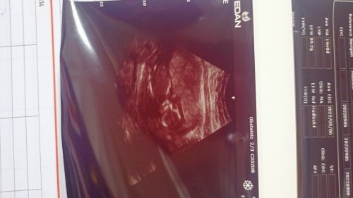 อัลตร้าซาวด์14สัปดาห์