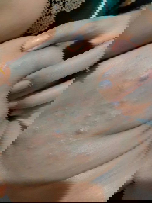 Bintik merah dipunggung bayi 2 bulan sampai perut