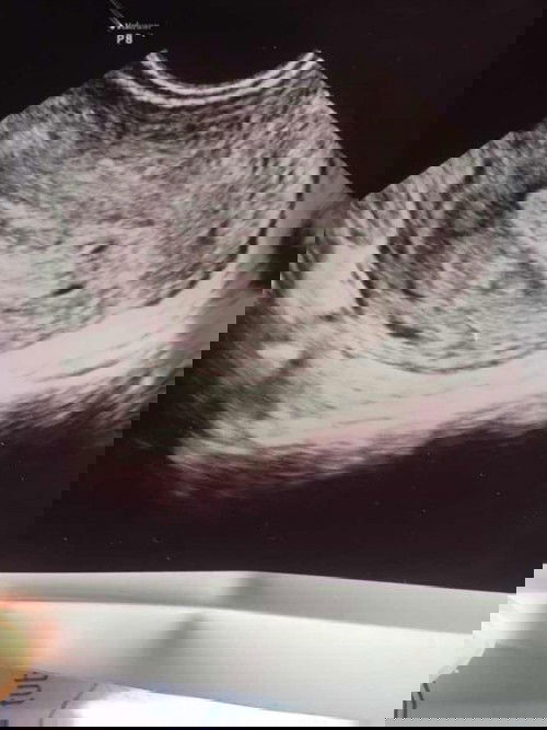 2x tespack positif. Tapi USG belum terlihat