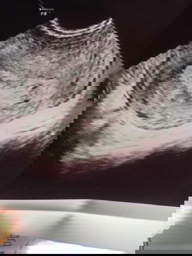 2x tespack positif. Tapi USG belum terlihat