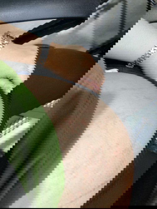 ท้องเป็นผื่น คัน มีใครเคยเป็นบ้างคะ