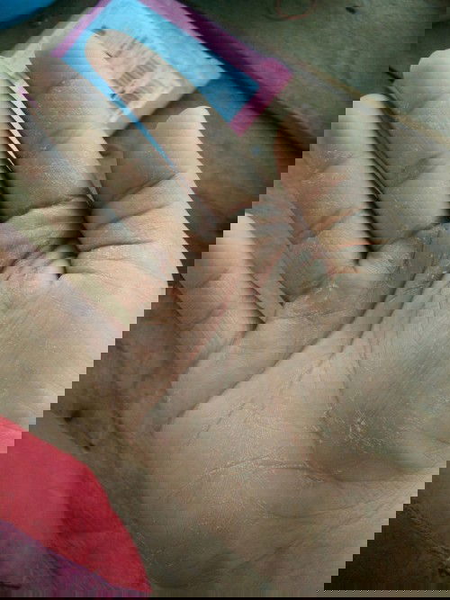 มือลอกแบบนี้เกิดจากอะไรค่ะ