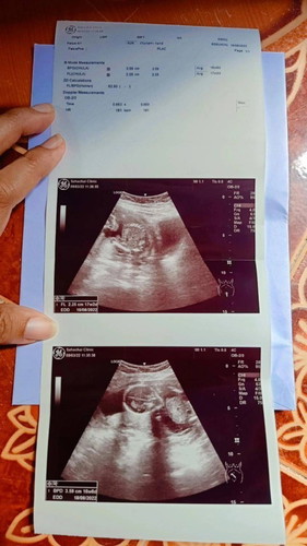 วันนี้ไปอัลตร้าซาวด์ดูเพศมา 17w2d คุณหมอบอกว่าตัวน้องยังเล็กมาก ยังดูเพศไม่ได้เลย