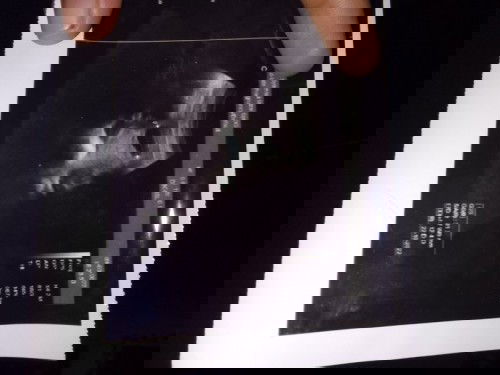 Pendarahan - Flek - Keguguran