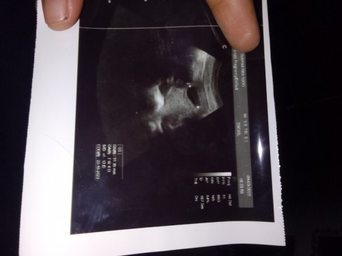 Pendarahan - Flek - Keguguran