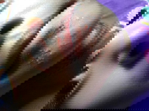 Bintik putih bernanah