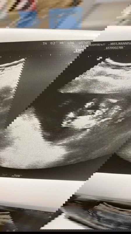 ท้องได้16สัปดาห์5วัน ช่วยดูหน่อยจ้า หญิงหรือชาย